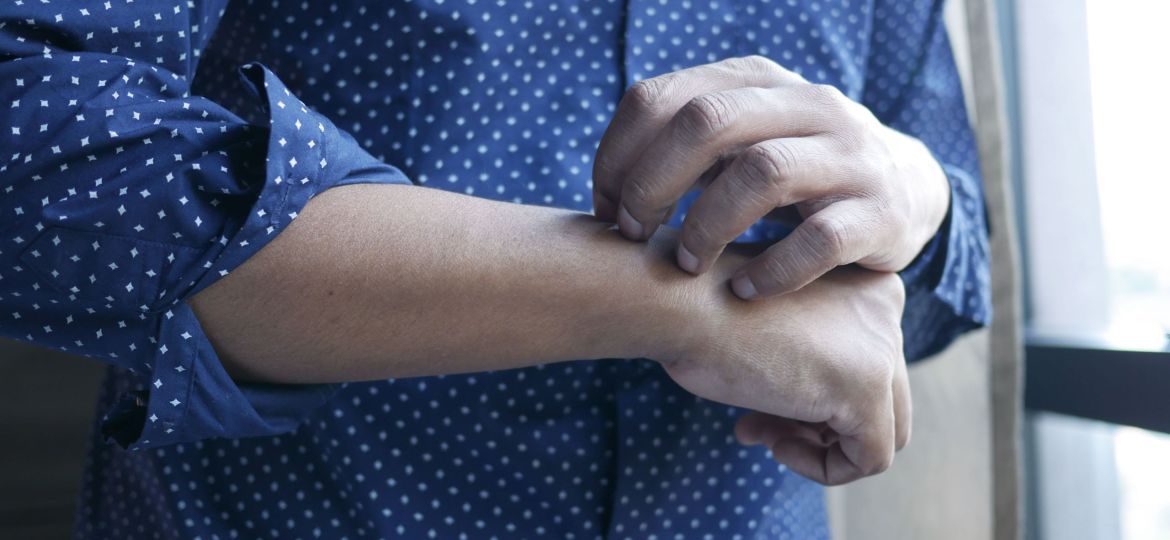 AegerPrima Eczema